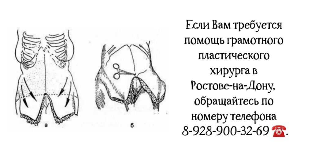 Еремеев Сергей Васильевич - пластический хирург Ростов - абдоминопластика 