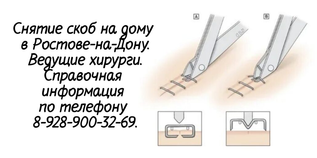 Хирург на дом Ростов - снять скобы