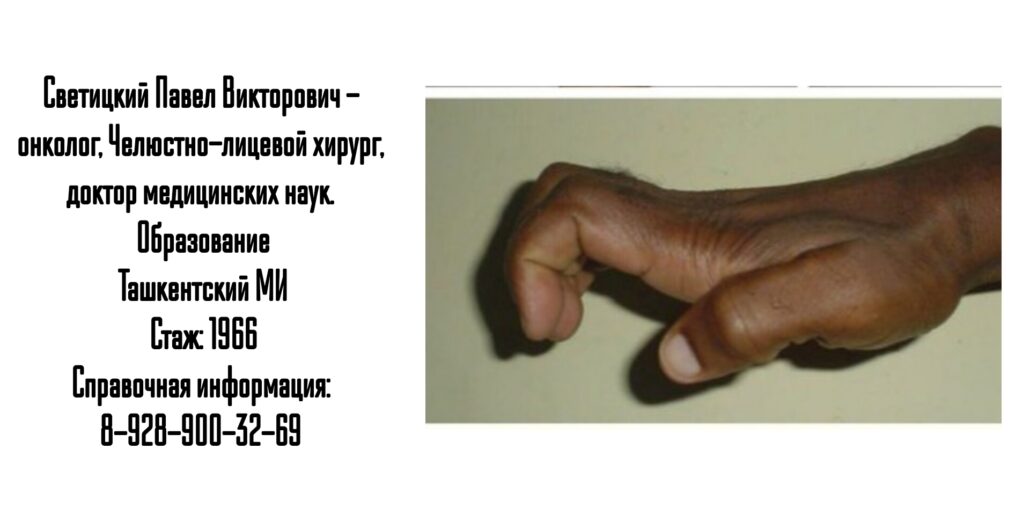 Силецкий Игорь Олегович - Синдром карпального канала — лечение Ростов 