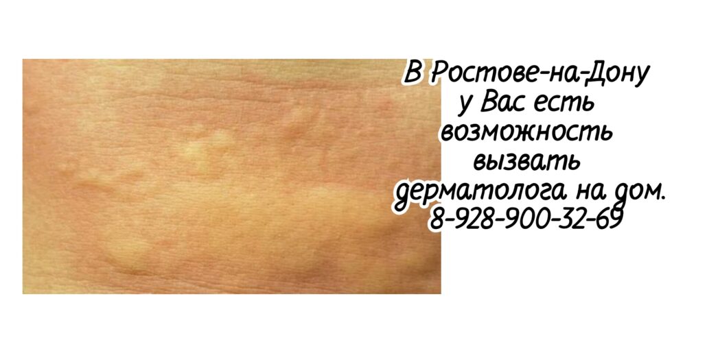 Вызвать дерматолога на дом в Ростове 