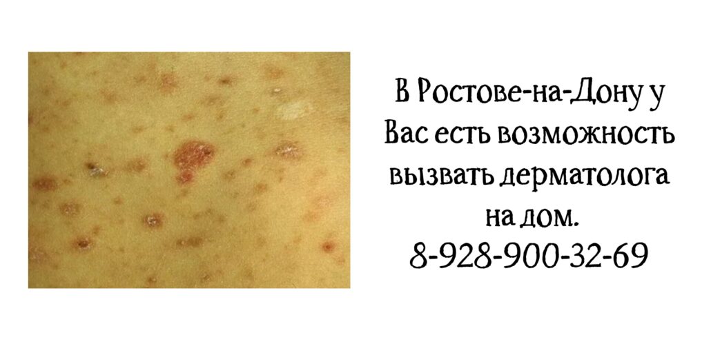 Вызвать дерматолога на дом в Ростове 