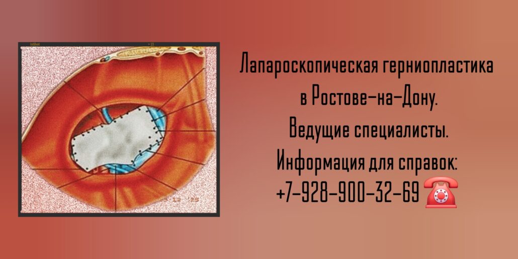 Лапароскопическая герниопластика - Ростов-на-Дону 