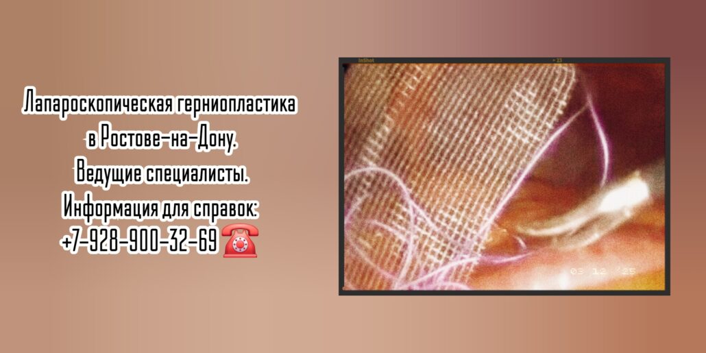 Лапароскопическая герниопластика - Ростов-на-Дону 