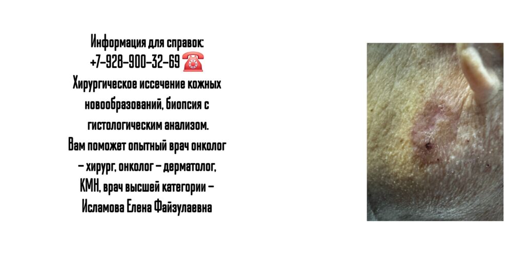 Базалиома - врач дерматолог-онколог Исламова Елена Файзулаевна 