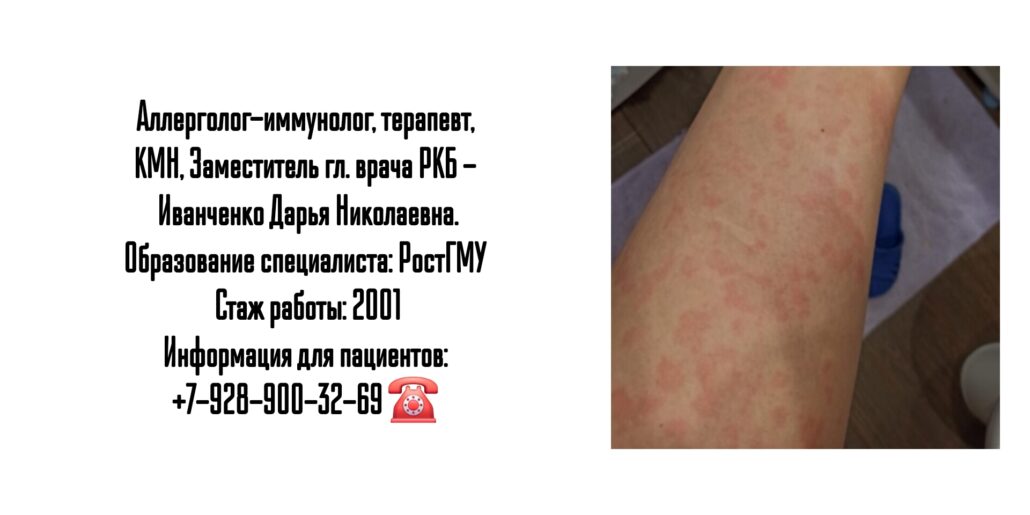 Иванченко Дарья Николаевна - аллерголог - иммунолог в Ростове-на-Дону