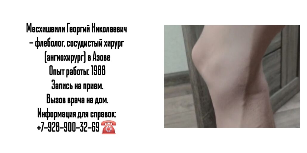 Сосудистый хирург  Азов - Месхишвили Георгий Николаевич