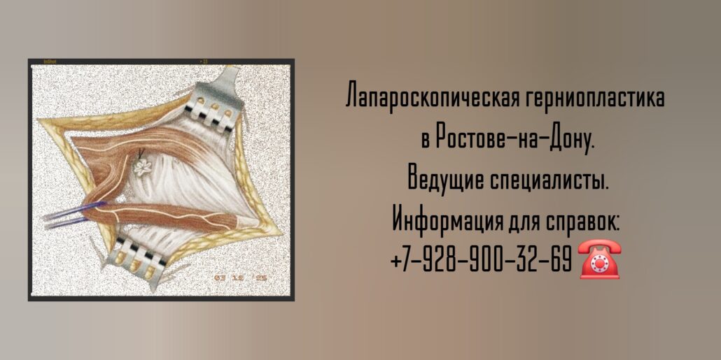 Лапароскопическая герниопластика - Ростов-на-Дону 