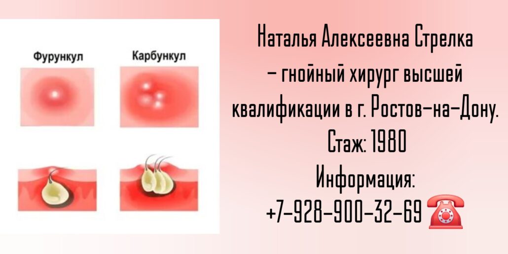 Стрелка Наталья Алексеевна - гнойный хирург Ростов-на-Дону
