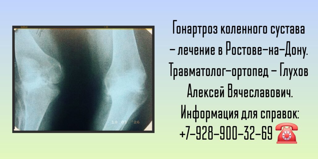 Гонартроз двусторонний коленного сустава - травматолог-ортопед Ростов - Глухов Алексей Вячеславович